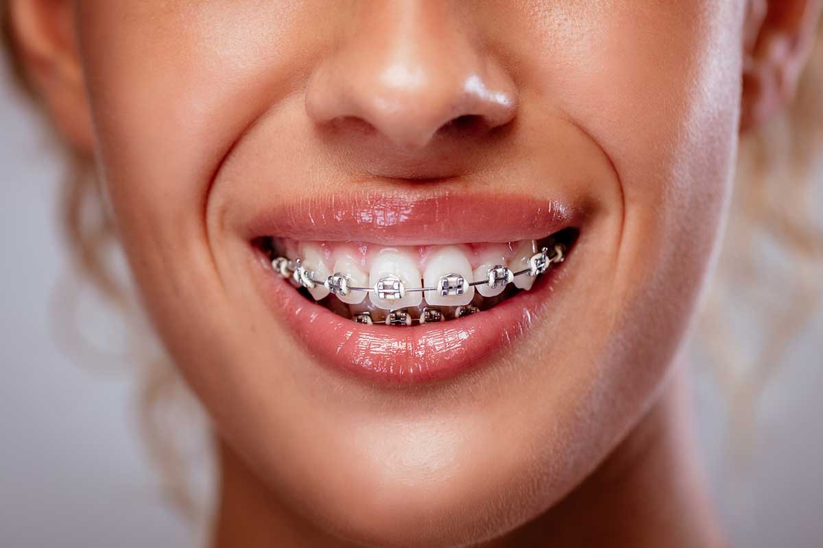 Tratament ortodontic la Davinci dental clinic Chisinau